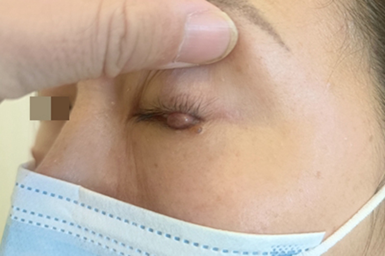 毛囊痣眼睑症状图