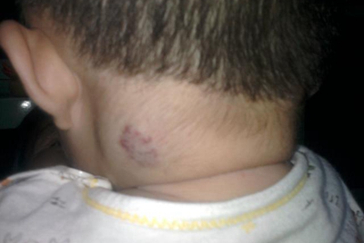 深在型婴儿血管瘤颈部皮肤发青图 深在型婴儿血管瘤颈部皮肤发青图