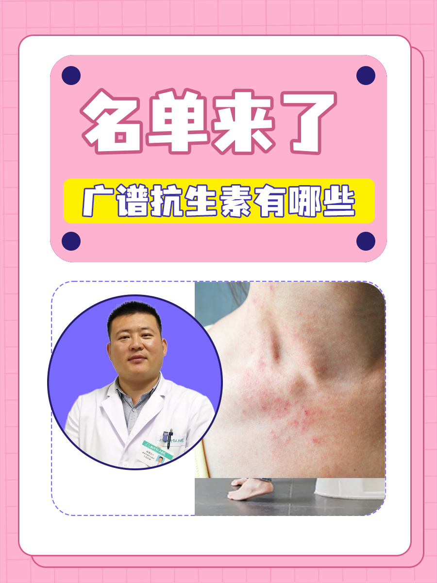 广谱抗生素有哪些 ，名单来了