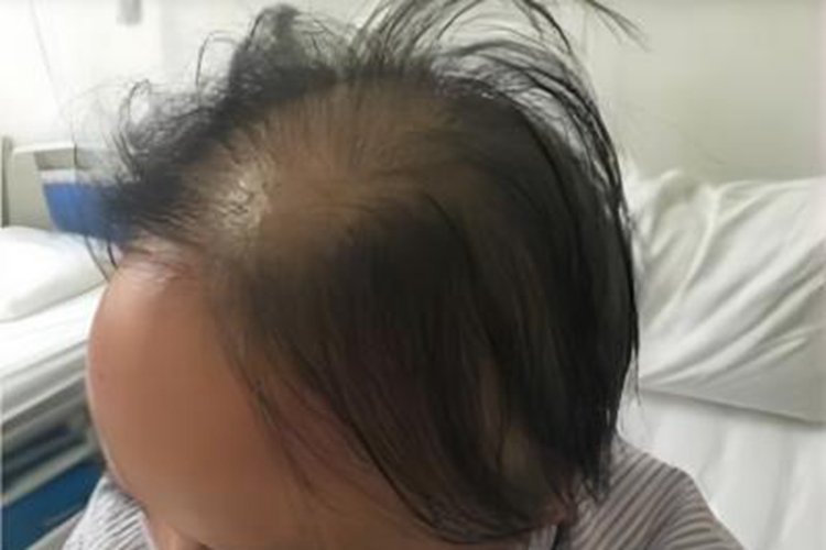 急性铊中毒脱发图 急性铊中毒脱发图