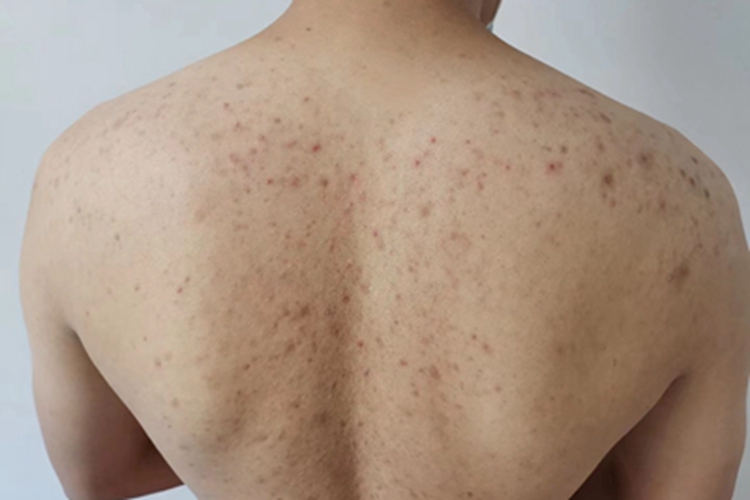 细菌性毛囊炎背部丘疹图 细菌性毛囊炎背部丘疹图