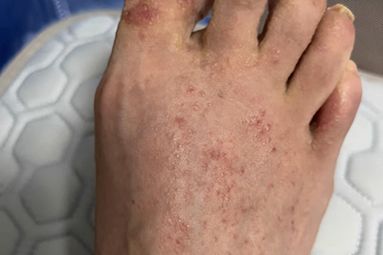 水疱型足癣脚背症状图