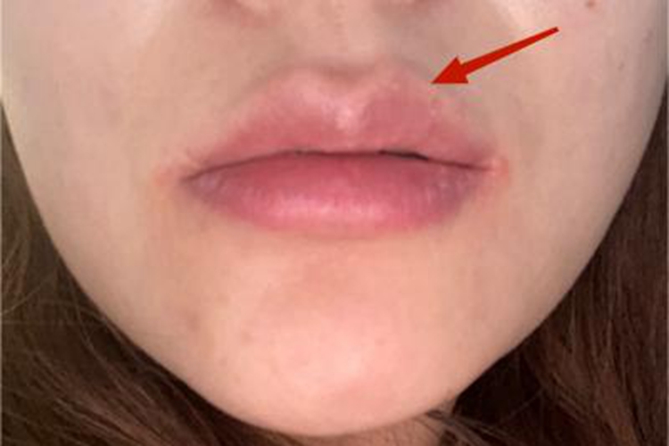 皮脂腺异位症嘴唇肿图