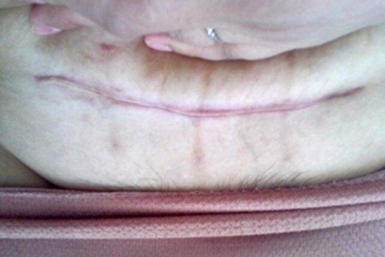 增生性瘢痕下腹有隆起瘢痕图