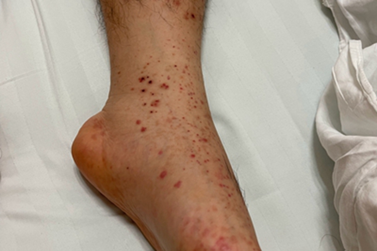 异常蛋白血症紫癜脚踝症状图