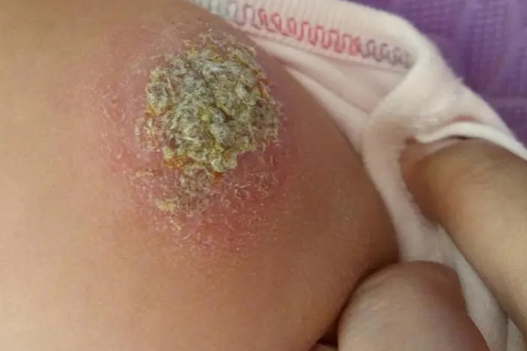 接种卡介苗伤口感染图 接种卡介苗伤口感染图