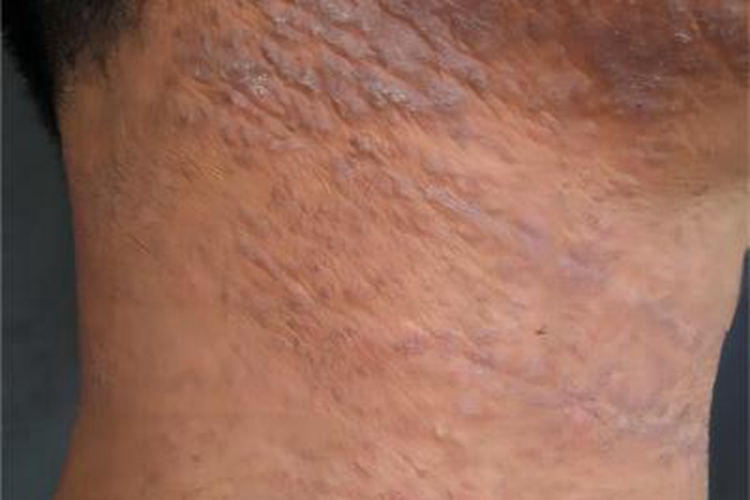 穿通性疾病颈部皮肤粗糙图