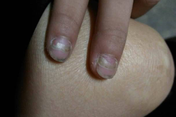 手足口病恢复期指甲盖分层脱落图 手足口病恢复期指甲盖分层脱落图