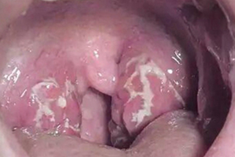 扁桃体炎白斑图 扁桃体炎白斑图