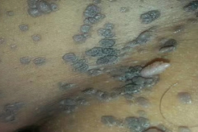 男性疣臀部症状图