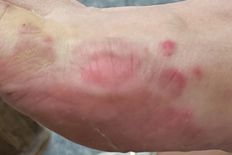 慢性湿疹脚部红斑图