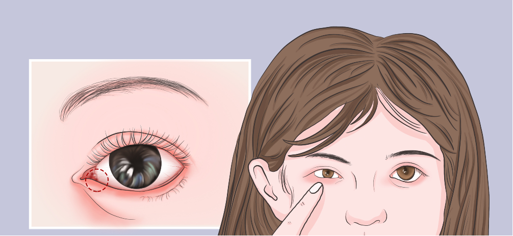 眼眶脂肪肉瘤 眼眶脂肪肉瘤