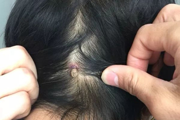 蜱咬伤头上伤口红肿图 蜱咬伤头上伤口红肿图