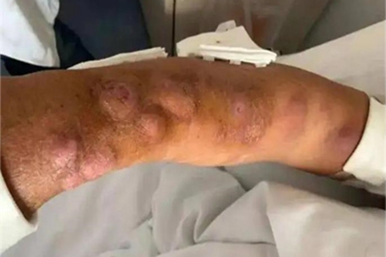 皮肤猪囊尾蚴病小疙瘩图