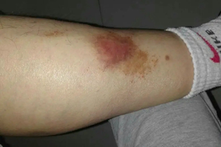 脂质渐进性坏死小腿红肿图