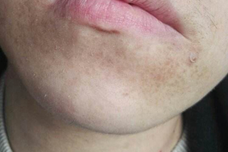 网状色素失禁症下巴症状图