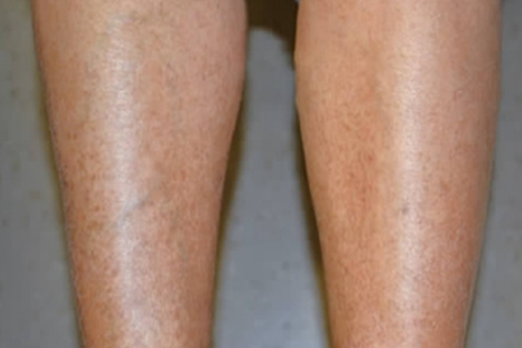 高球蛋白血症性紫癜小腿症状图 高球蛋白血症性紫癜小腿症状图