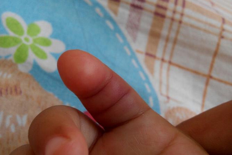 化脓性指头炎肿胀图