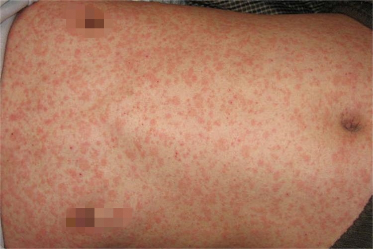 过敏皮肤红斑图 过敏皮肤红斑图