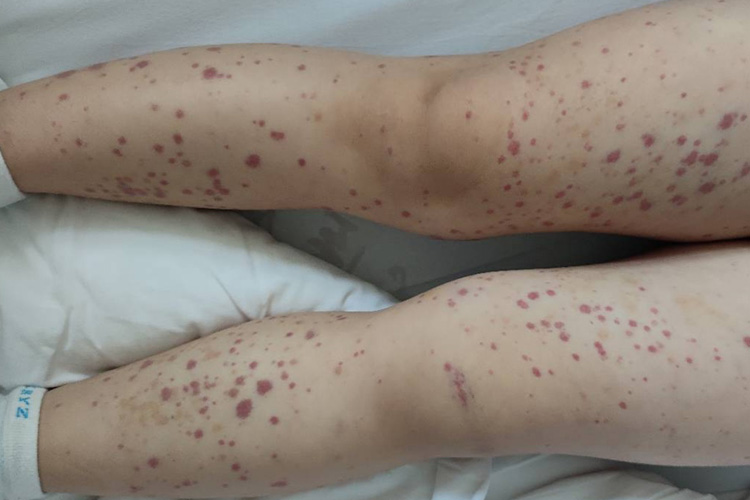 皮下血点图 皮下血点图