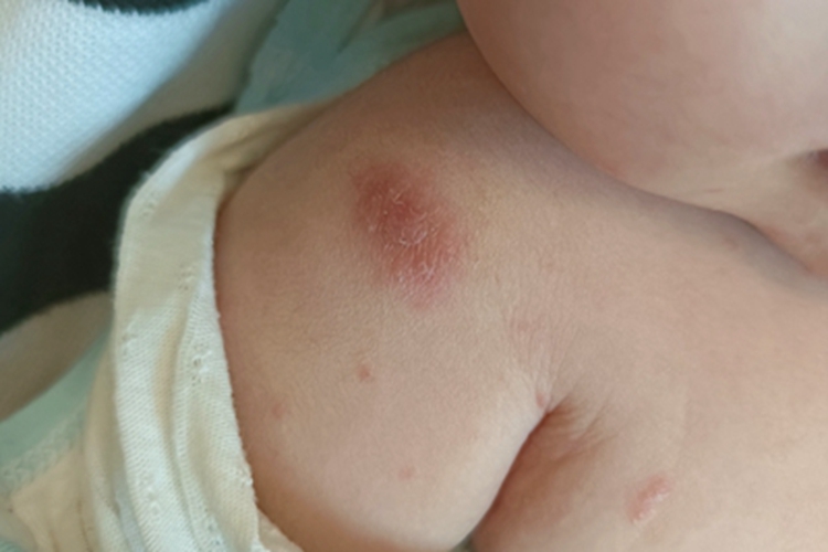 慢性湿疹症状图片