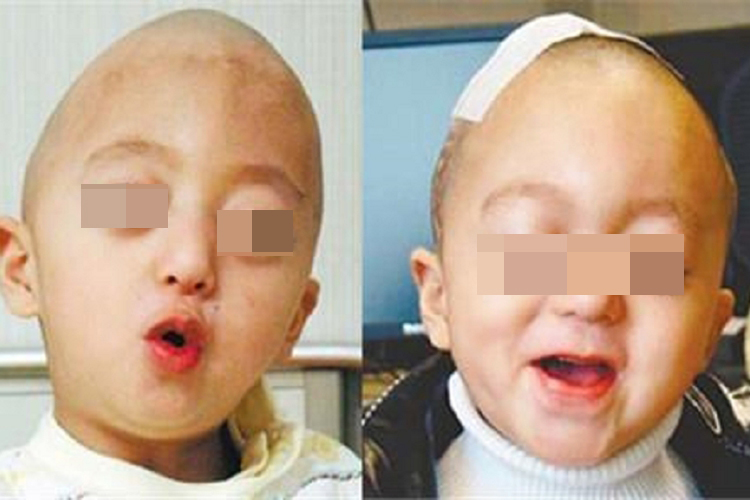 狭颅症尖头畸形图