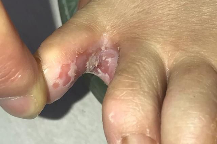 浸渍糜烂型足癣糜烂图 浸渍糜烂型足癣糜烂图