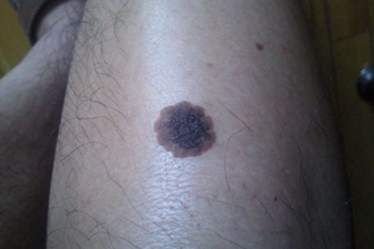 浅表扩散性黑素瘤小腿黑斑图 浅表扩散性黑素瘤小腿黑斑图