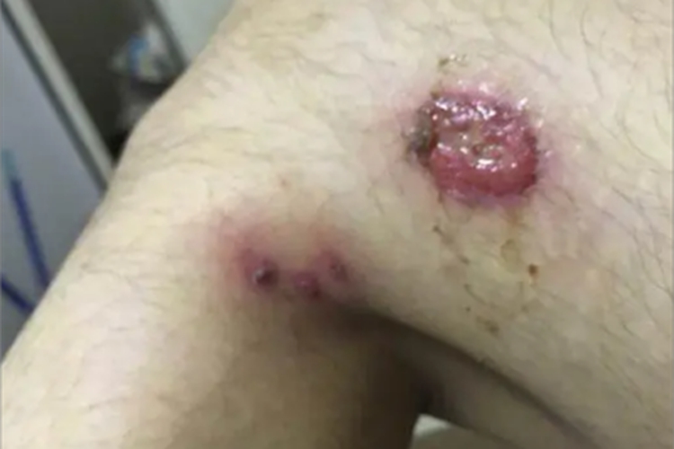 皮肤利什曼病大腿溃疡图