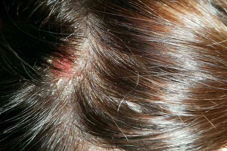 头皮脂溢性皮炎图 头皮脂溢性皮炎图