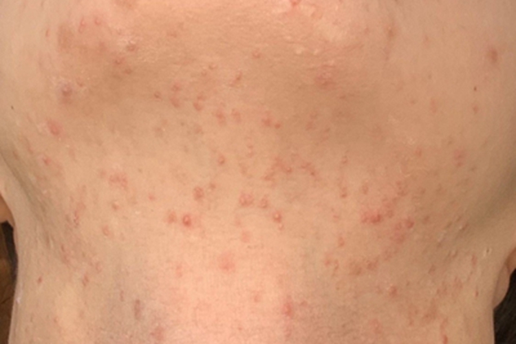 马拉色菌毛囊炎前颈小疙瘩图