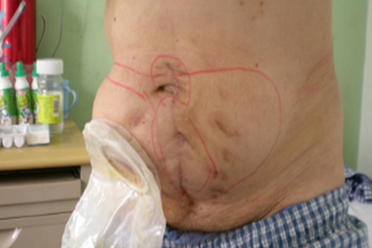 白线疝回纳后腹部凹陷图