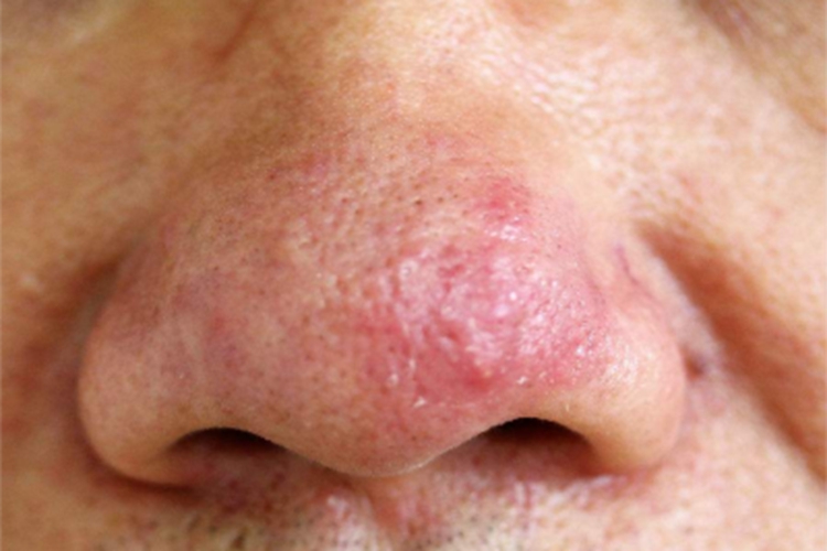 鼻赘型玫瑰痤疮鼻尖症状图