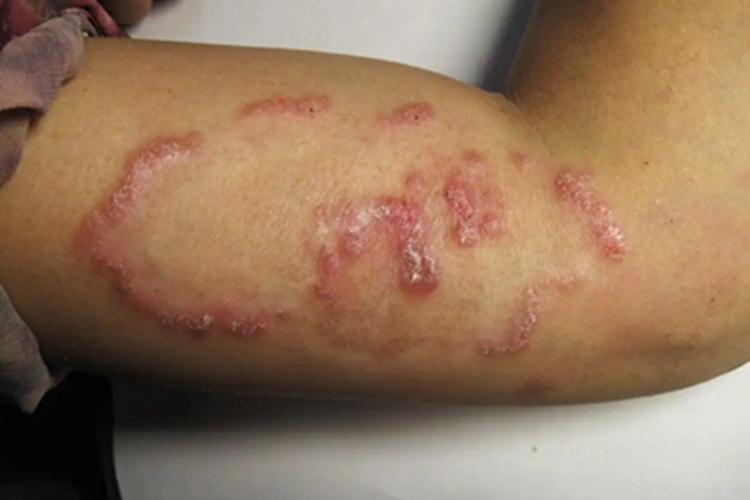 离心性环状红斑胳膊症状图