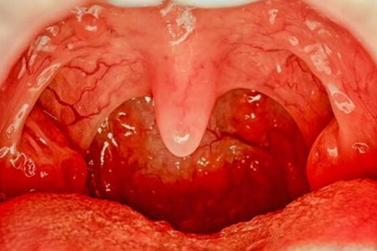 女性淋病的咽部症状图