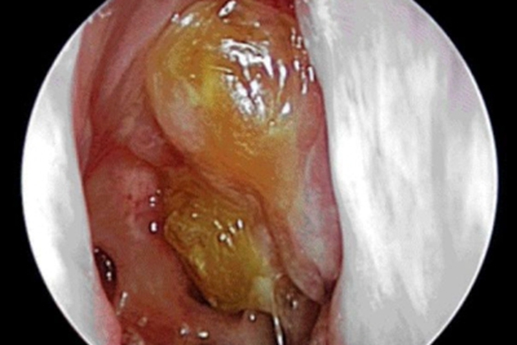 慢性化脓性鼻窦炎鼻腔有脓黄涕图