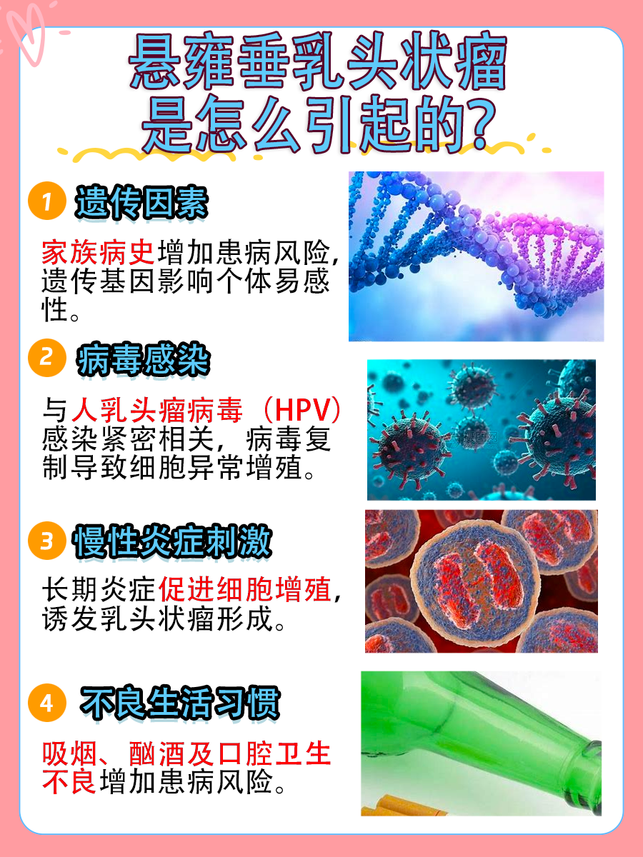 悬雍垂乳头状瘤发病原因，一文带你了解