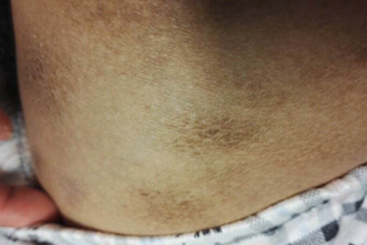 毛细血管扩张性环状紫癜臀部斑图