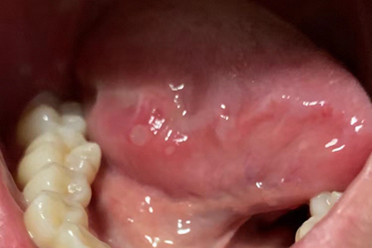口腔溃疡舌下有白斑图
