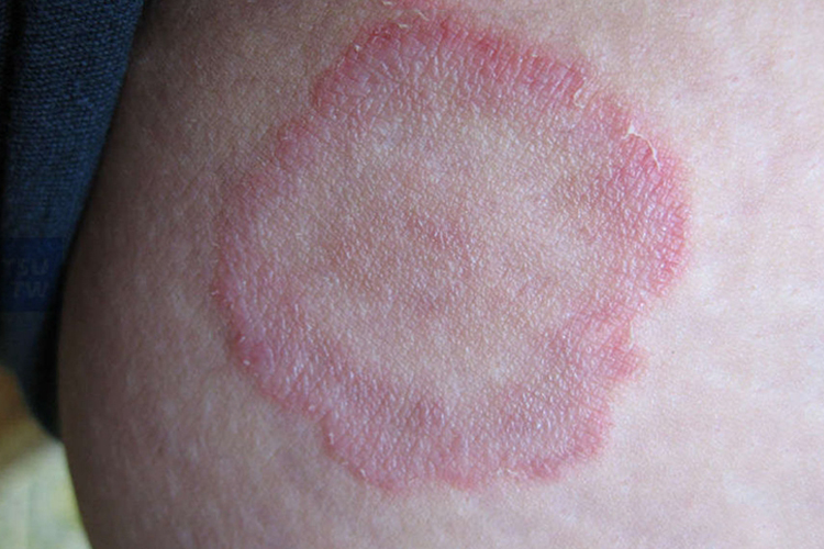 体癣环形皮疹图