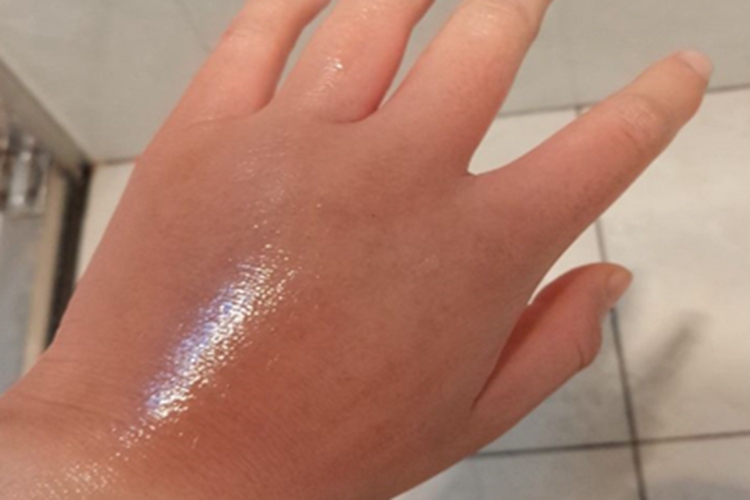 一度烫伤手背红肿图