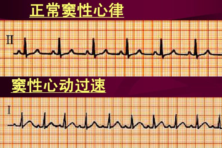 窦性心动过速心电图