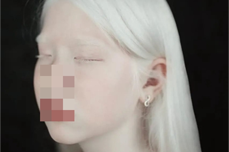 眼皮肤白化病头发变白图