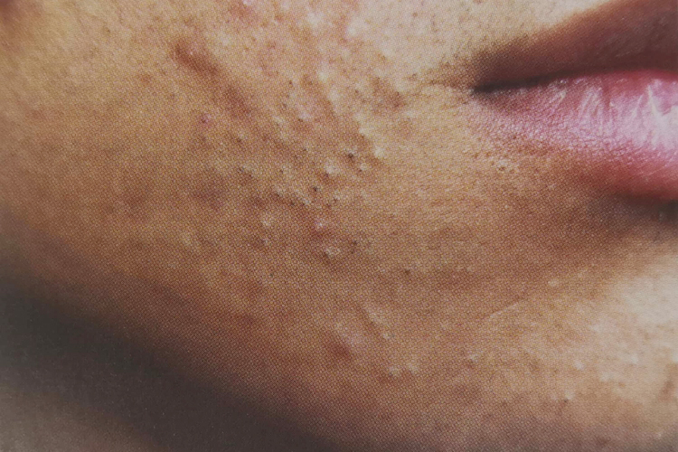 青春期男孩脸上长痘痘图