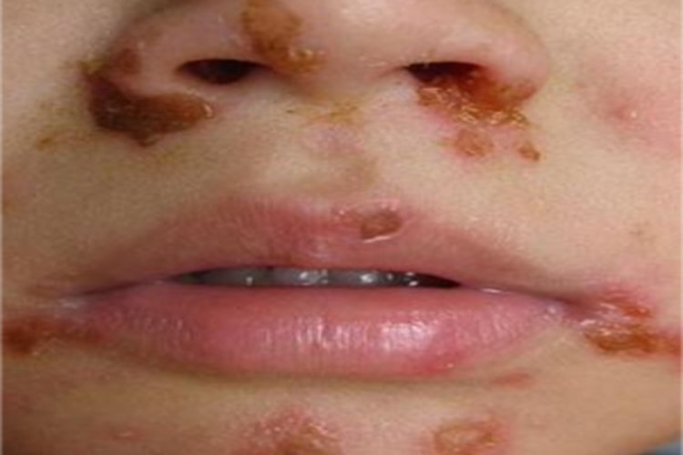 接触传染性脓疱疮口周糜烂黄痂图