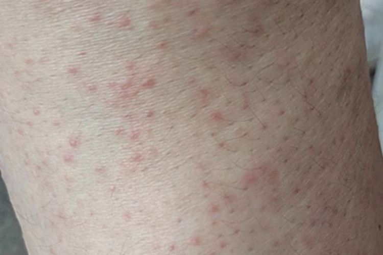 慢性接触性皮炎小腿丘疹图