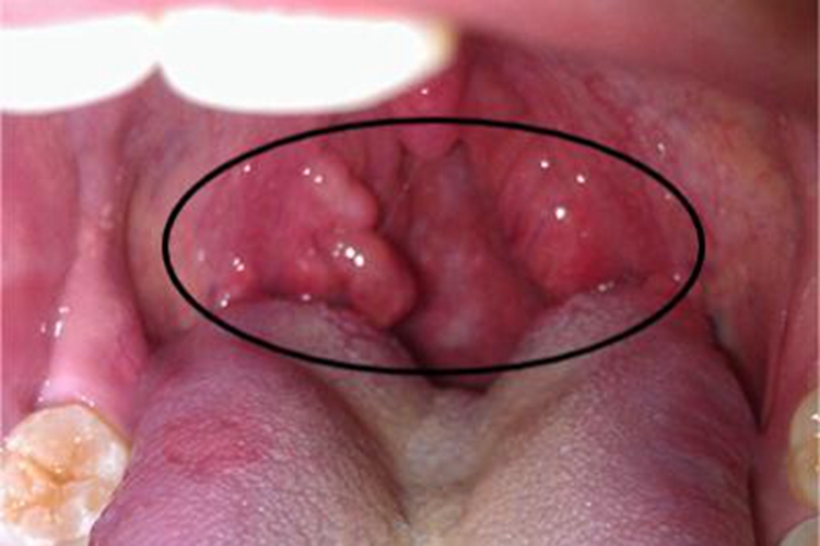 男性三期梅毒咽喉症状图 男性三期梅毒咽喉症状图