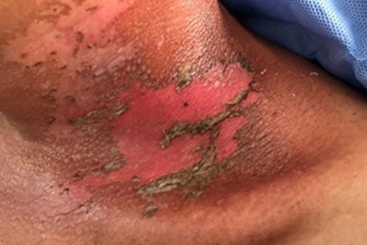 Ⅱ度急性放射性皮炎症状图