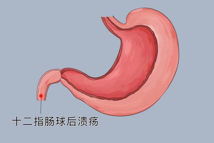 十二指肠球后溃疡位置图