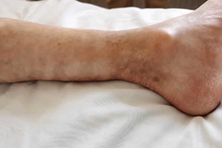 系统性硬皮病小腿皮肤萎缩图 系统性硬皮病小腿皮肤萎缩图